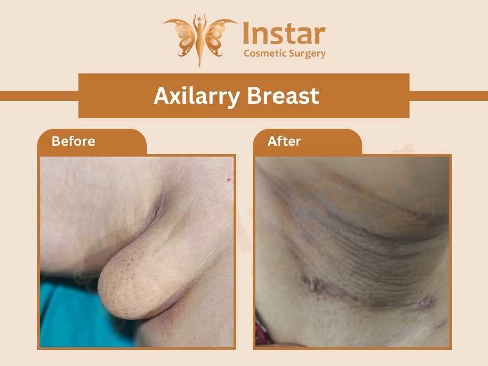 Axilarry-Breast-1