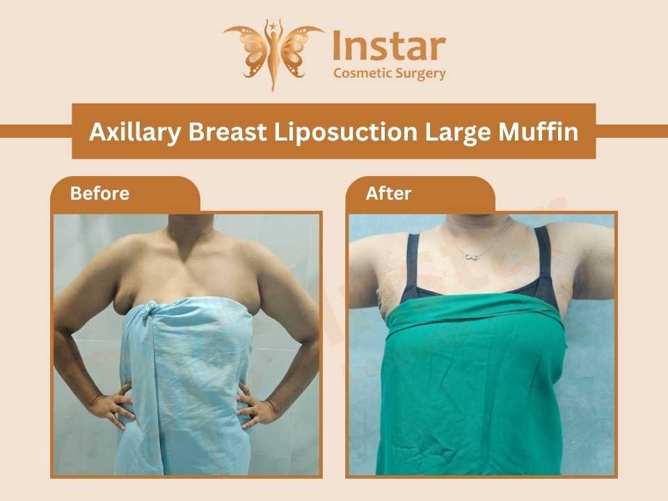 Axillary-Breast-Liposuction-Large-Muffin