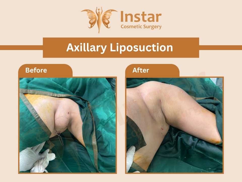 Axillary-breast-liposuction-2