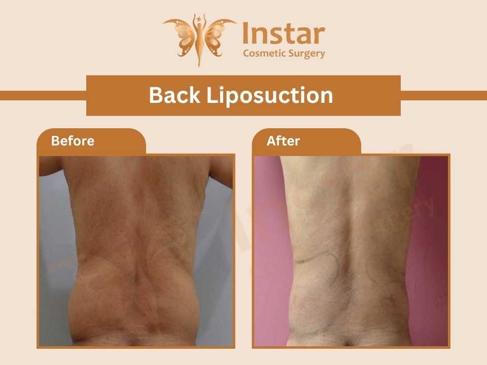 Back-liposuction-3