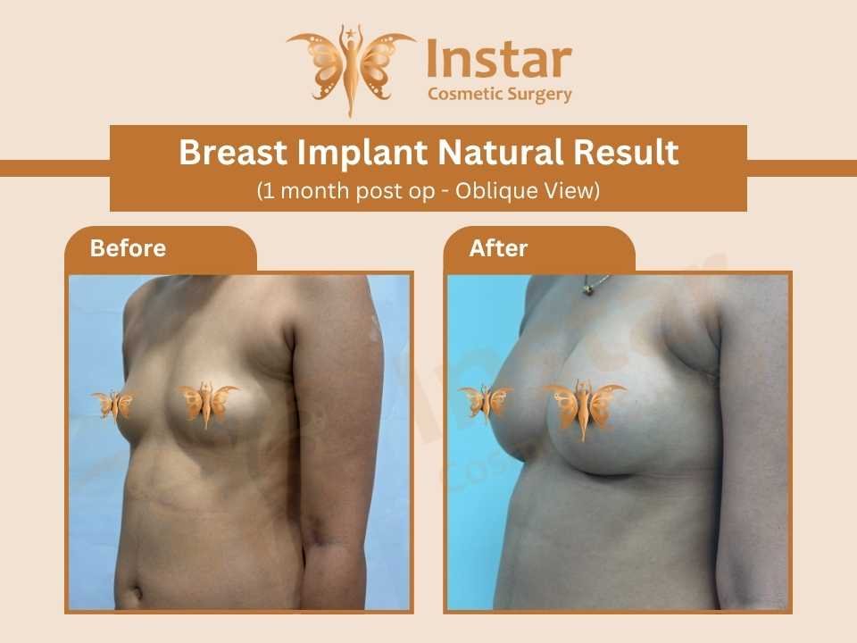Breast-Implant-Natural-Result-1-month-post-op-obilique-View