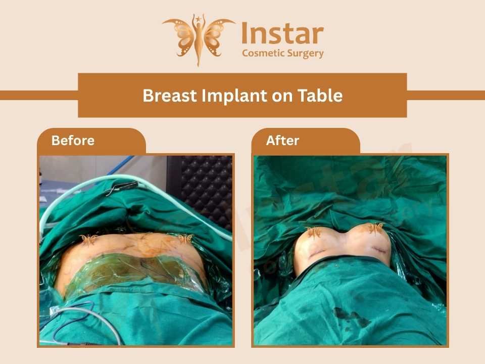 Breast-Implant-on-Table-1