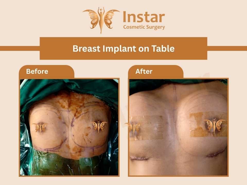Breast-Implant-on-Table-2