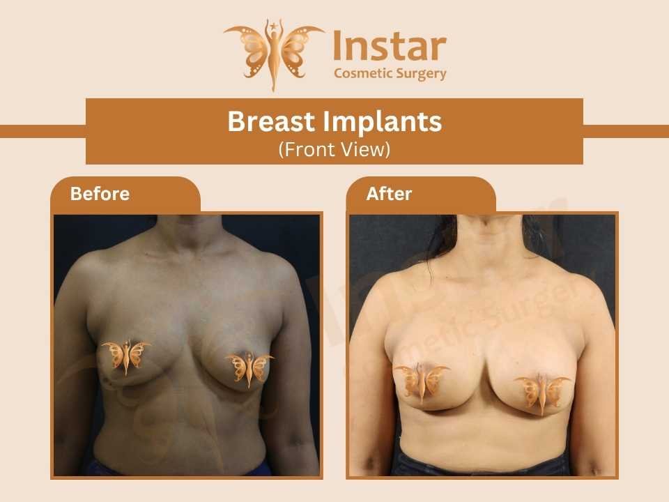 Breast-Implants-Front-View