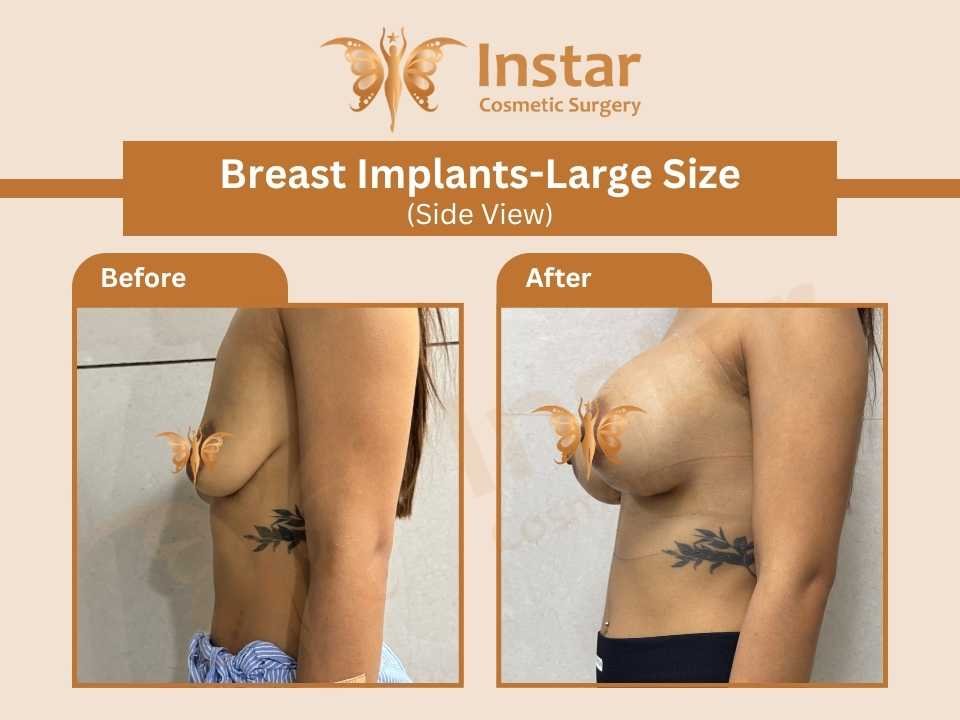 Breast-Implants-Large-Size-Side-View