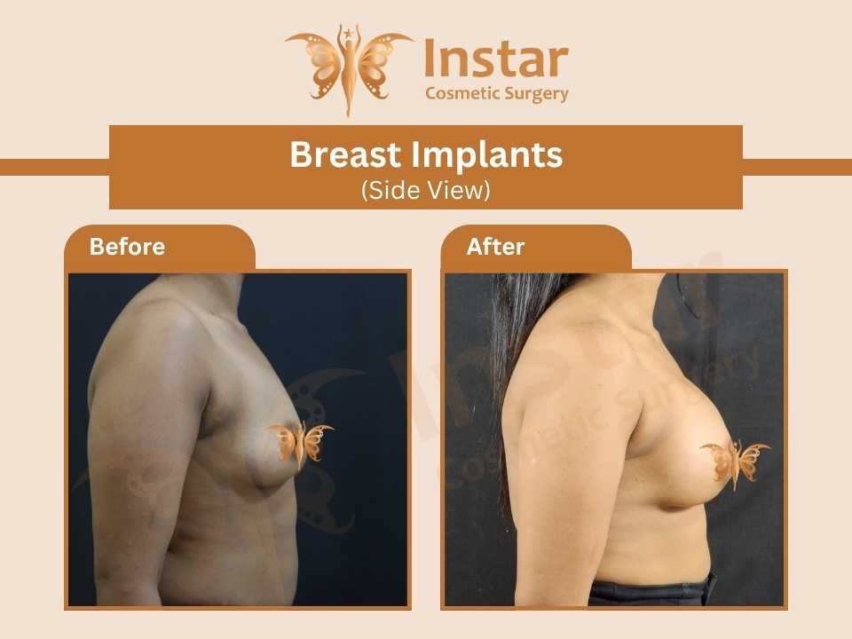 Breast-Implants-Side-View