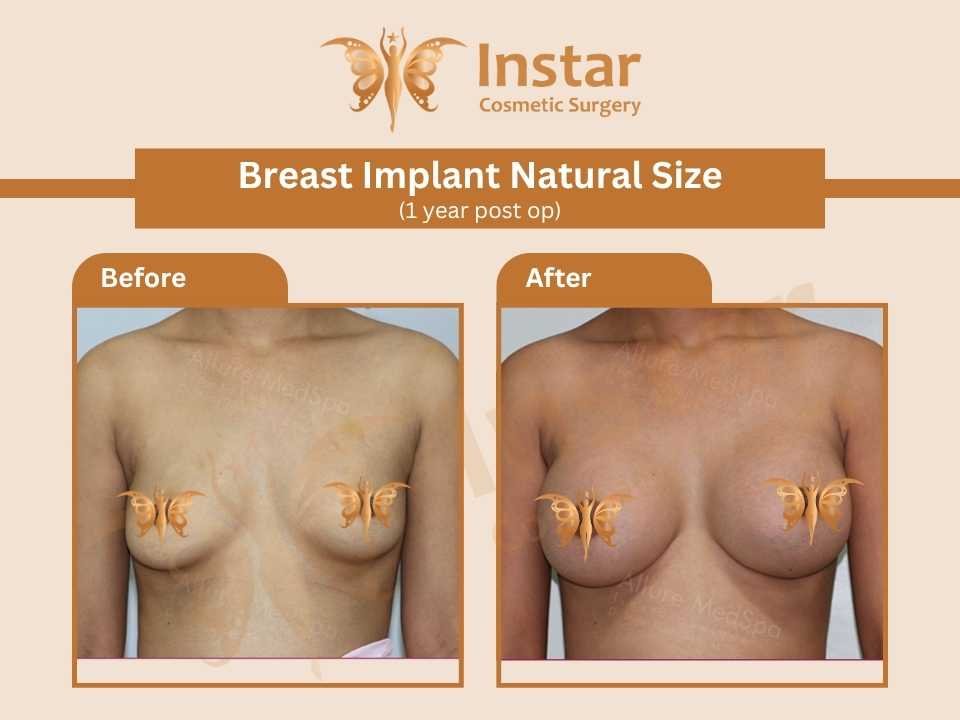 Breast-implant-natural-size-1-year-post-op