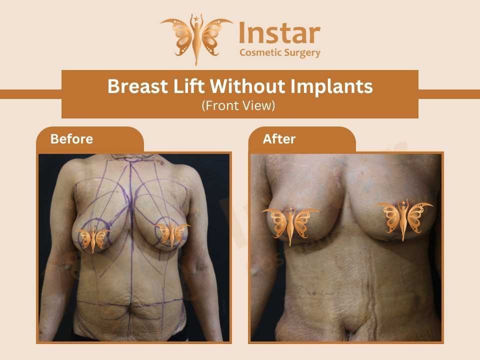 Breast-lift-without-implants-Front-view-2