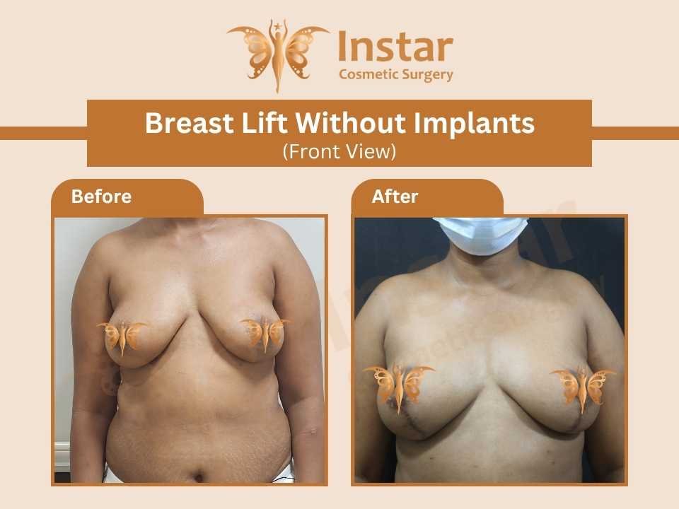 Breast-lift-without-implants-front-view-1