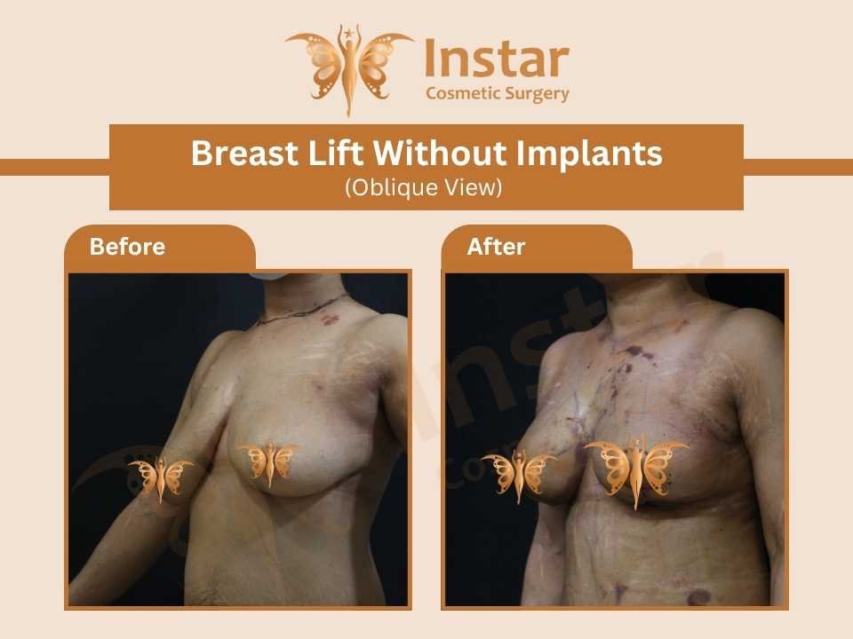 Breast-lift-without-implants-oblique-view-2