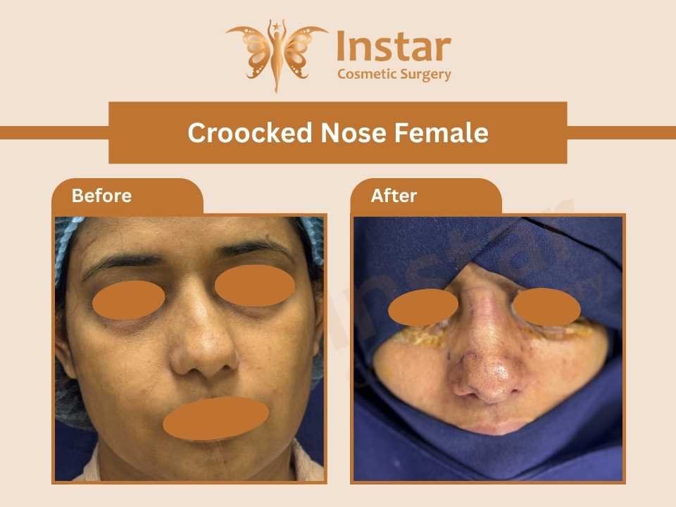Croocked-Nose-Female
