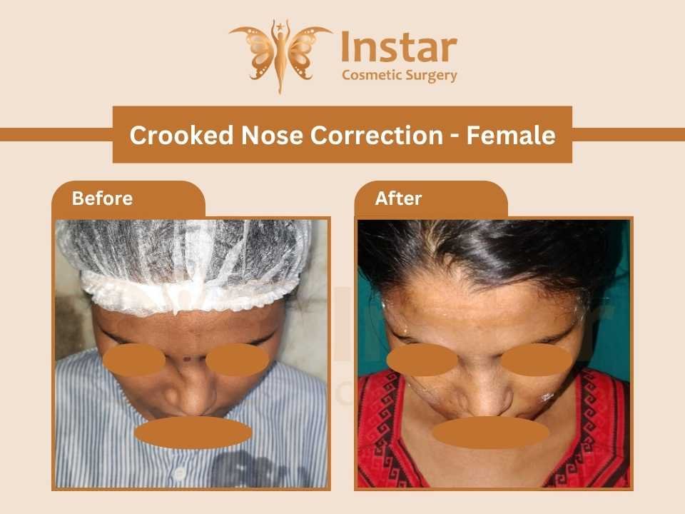 Crooked-Nose-Correction-Female