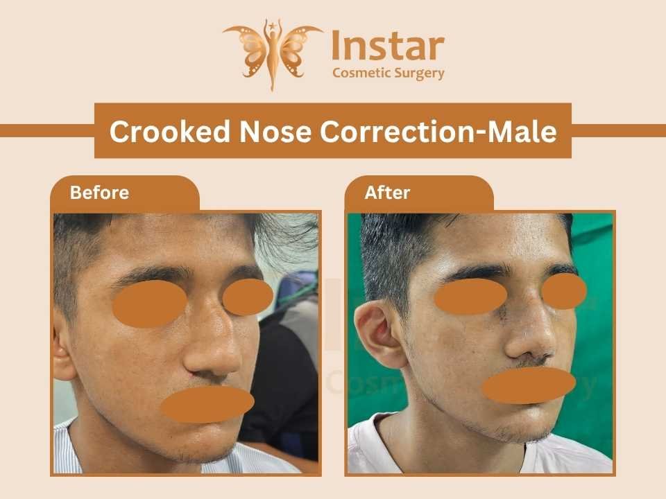 Crooked-Nose-Correction-Male