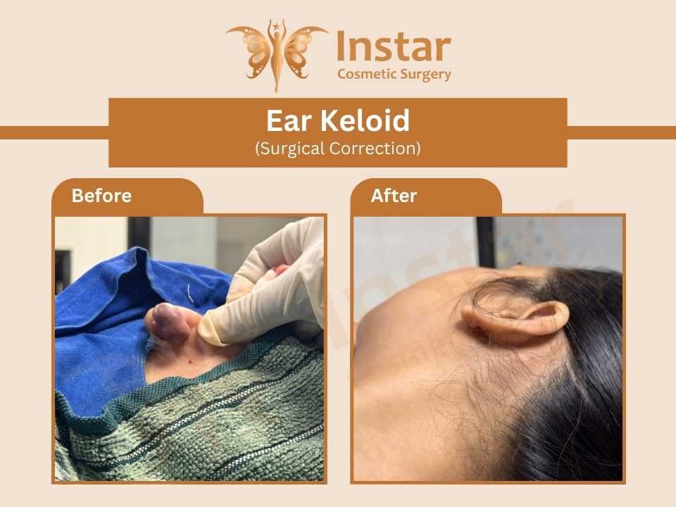 Ear-Keloid-surgical-correction-2