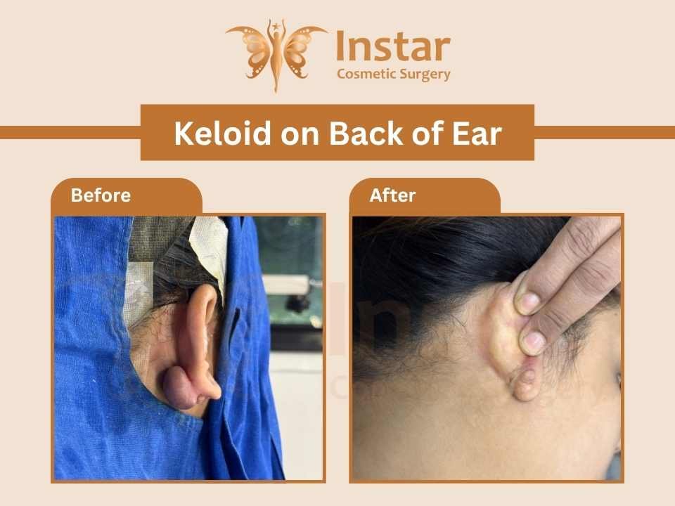 Ear-Keloids-back-of-ear-2