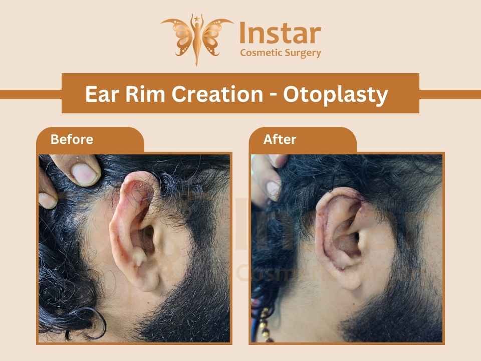 Ear-Rim-Creation-Otoplasty
