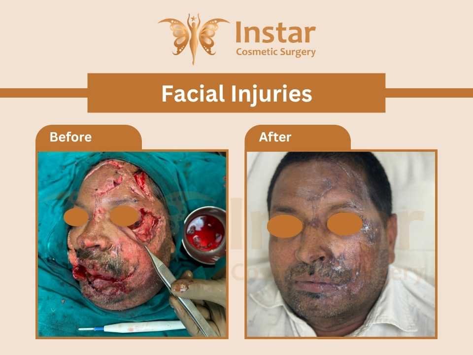 Facial-Injuries-1