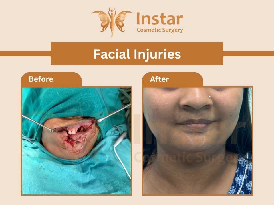 Facial-Injuries-2