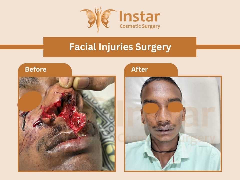 Facial-Injuries-Surgery-2