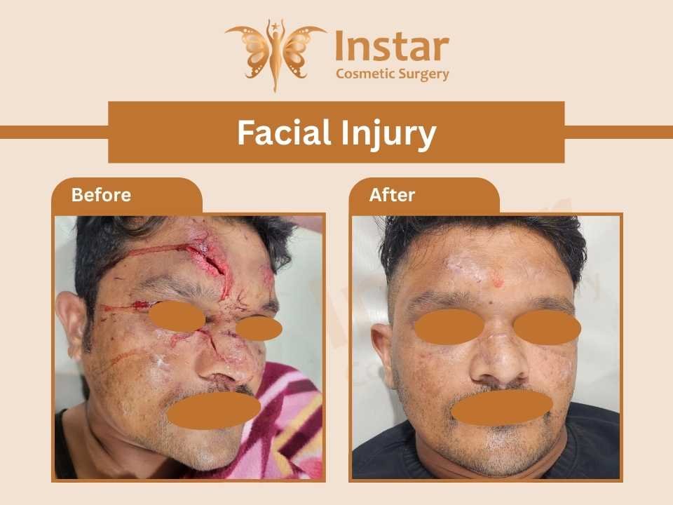 Facial-Injury