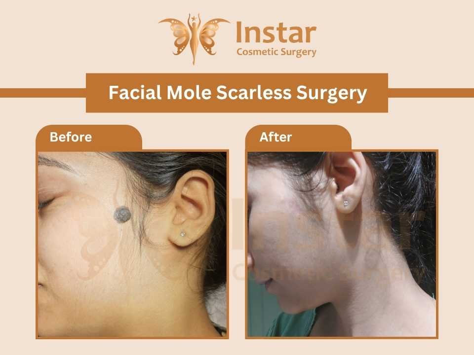Facial-Mole-scarless-surgery