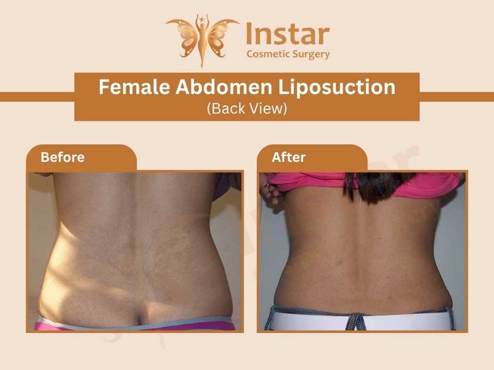 Female-Abdomen-Liposuction-Back-View-2