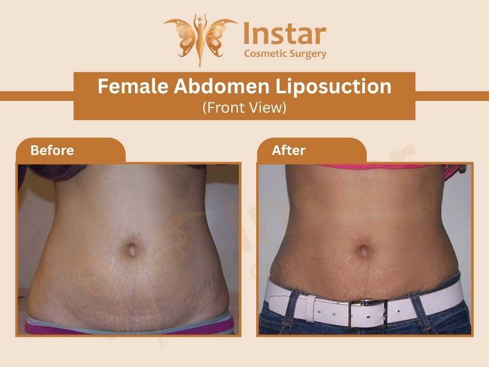 Female-Abdomen-Liposuction-Front-View-2