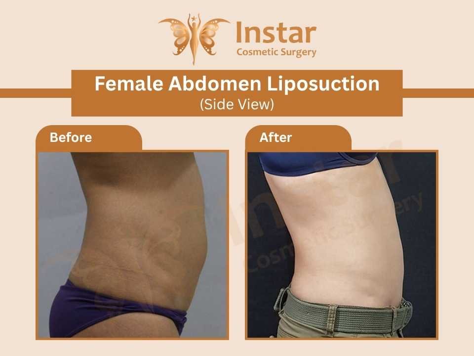 Female-Abdomen-Liposuction-Side-View-1