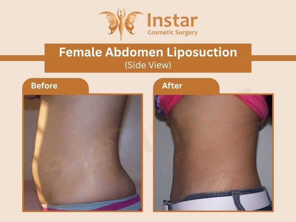 Female-Abdomen-Liposuction-Side-View-2