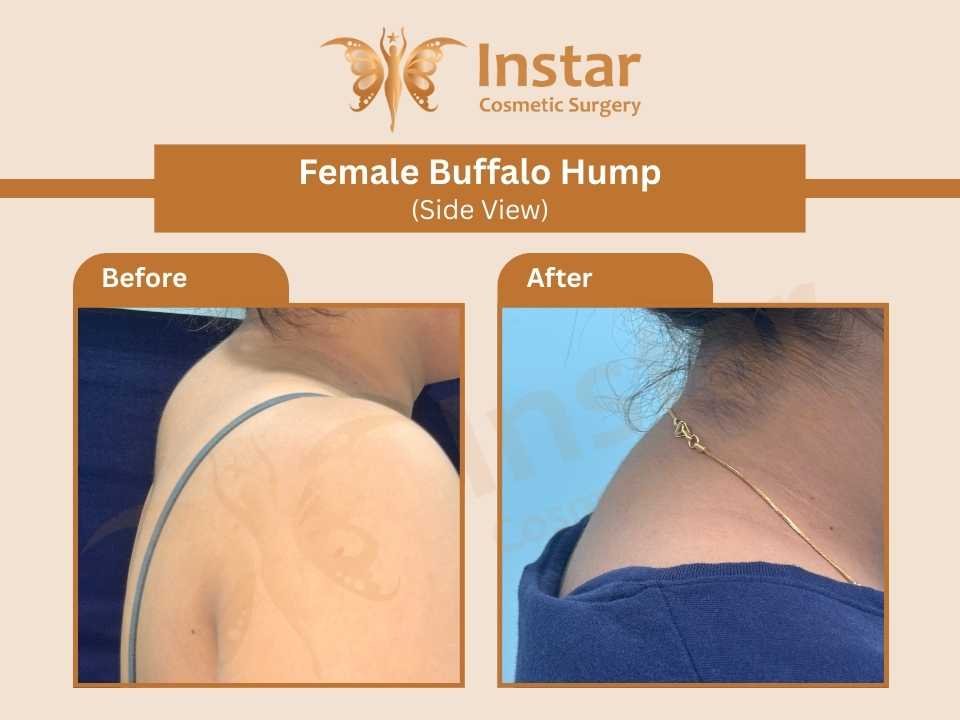 Female-Buffalo-Hump-side-view