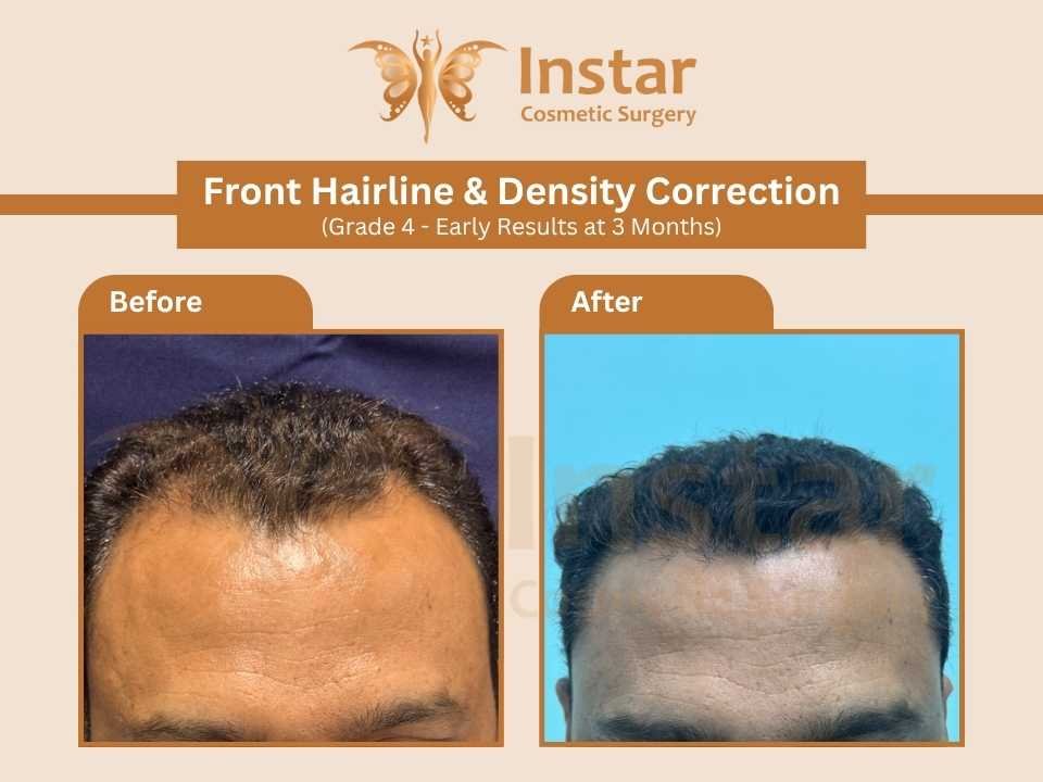 Front-Hairline-Density-Correction-grade4-Early-Results-at-3-Months