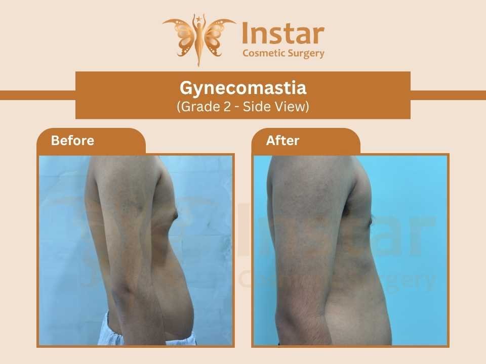 Gynecomastia-Grade-2-Side-View