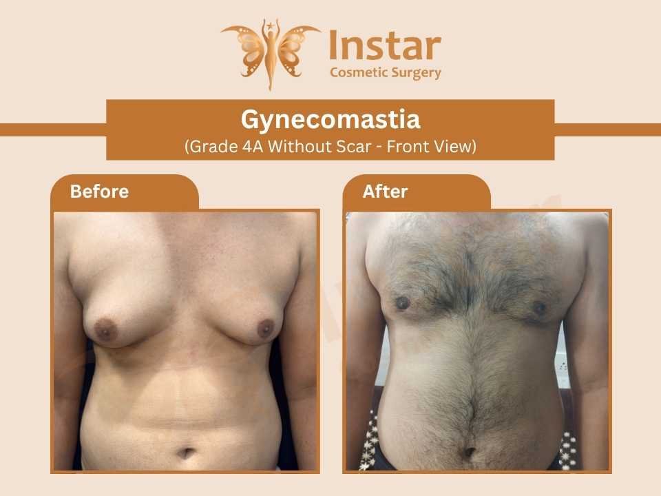 Gynecomastia-Grade-4A-Without-Scar-Front-View