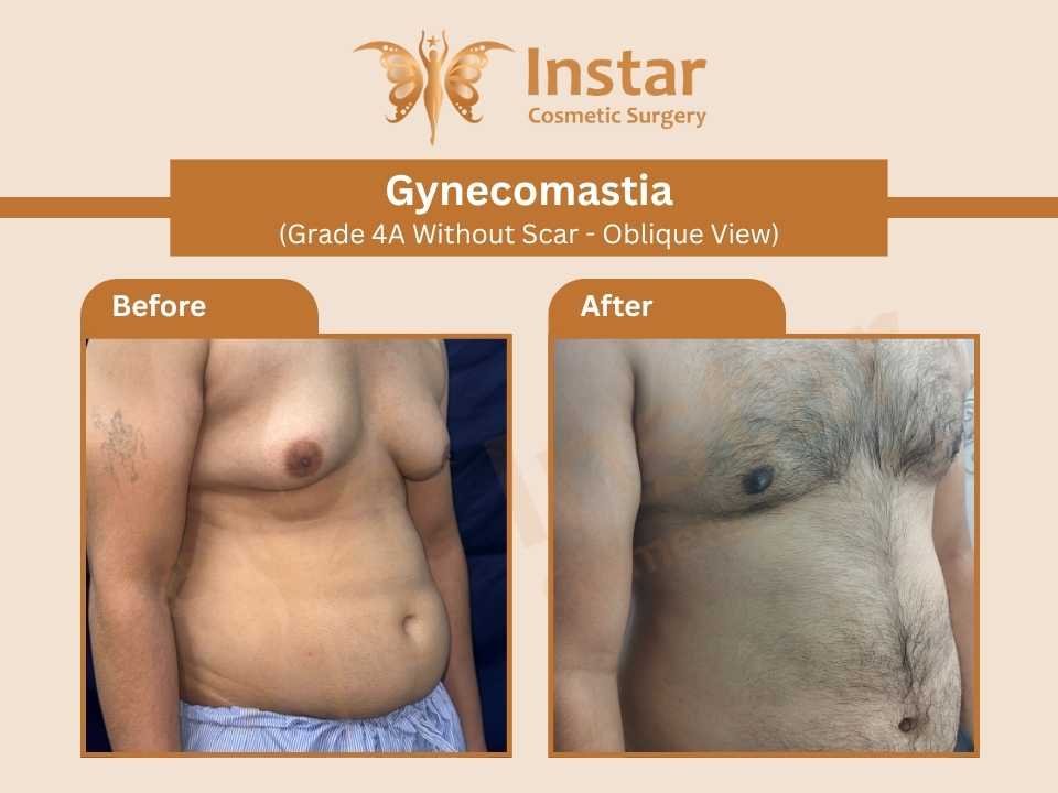 Gynecomastia-Grade-4A-Without-Scar-Oblique-View