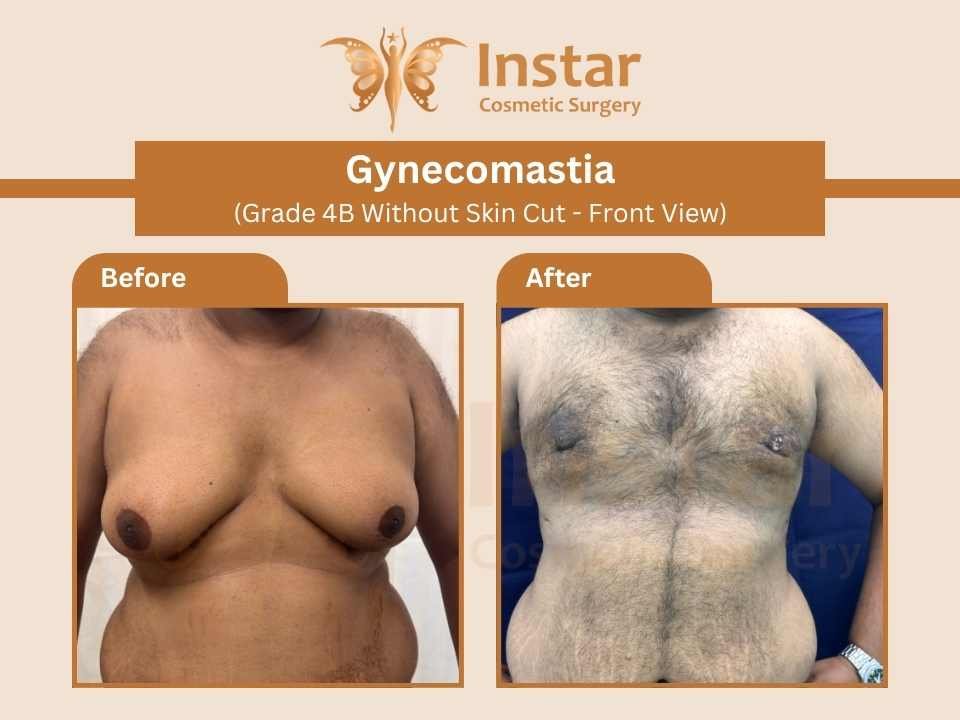 Gynecomastia-Grade-4B-Without-Skin-Cut-Front-View