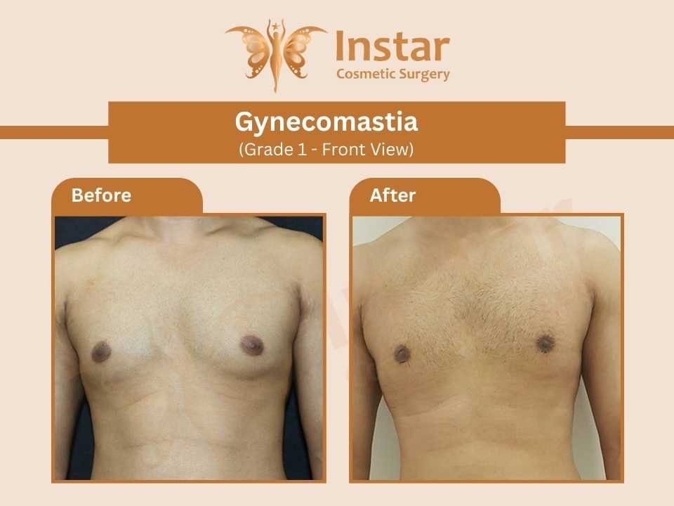 Gynecomastia-Grade1-Front-View