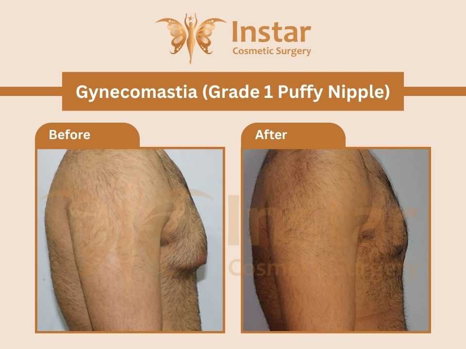 Gynecomastia-Grade1-puffy-nipple