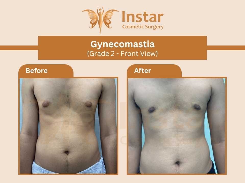 Gynecomastia-Grade2-Front-View