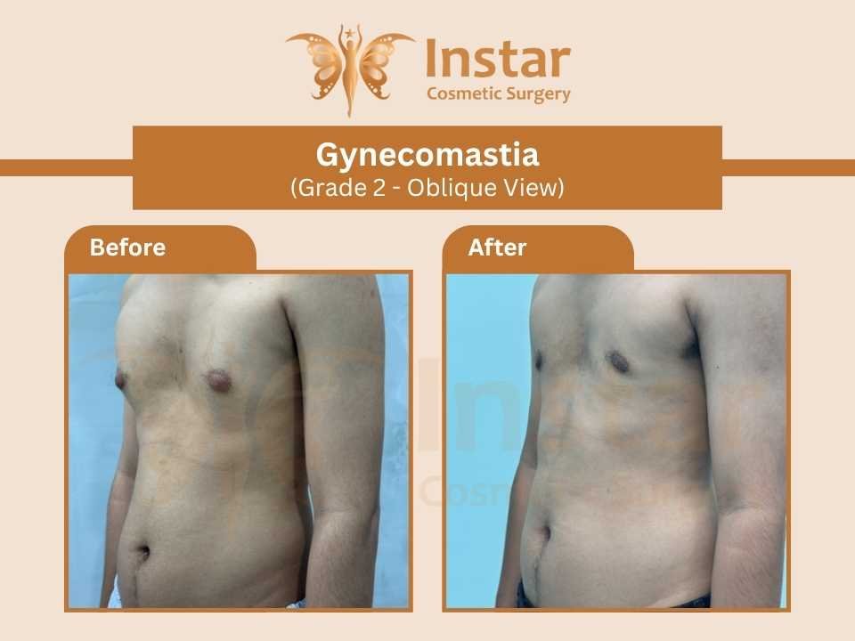Gynecomastia-Grade2-Oblique-View