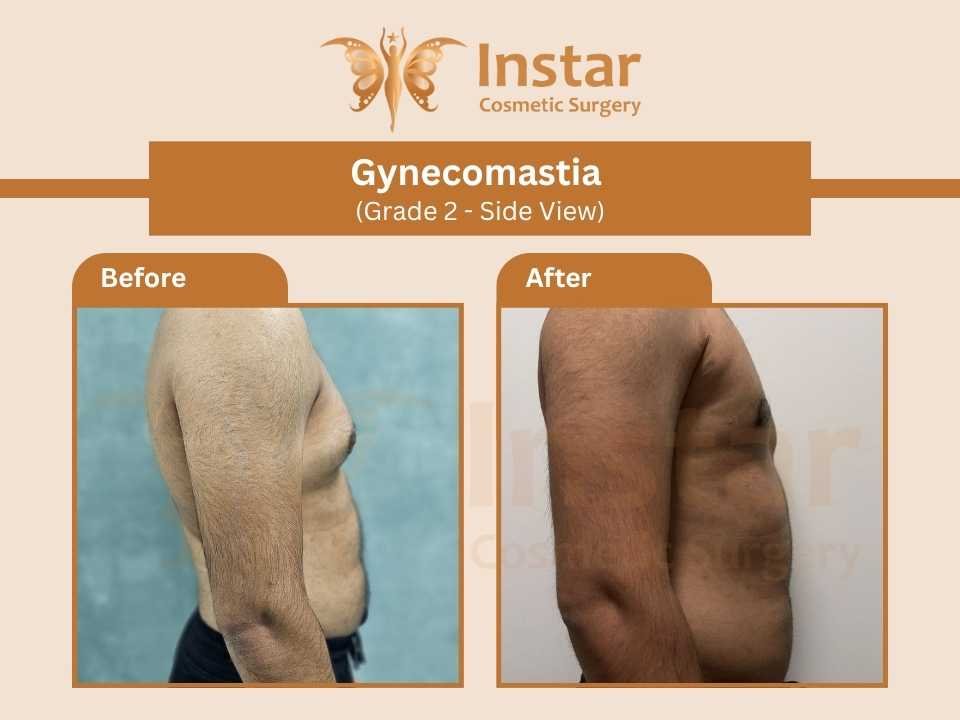 Gynecomastia-Grade2-Side-View