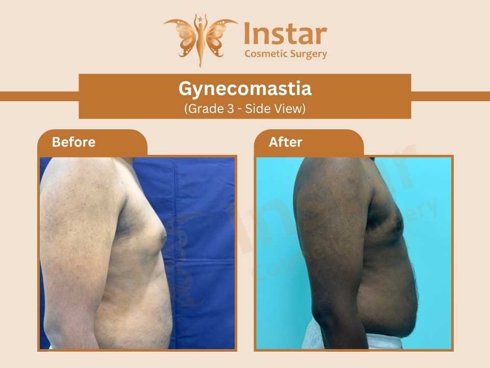 Gynecomastia-Grade3-Side-View