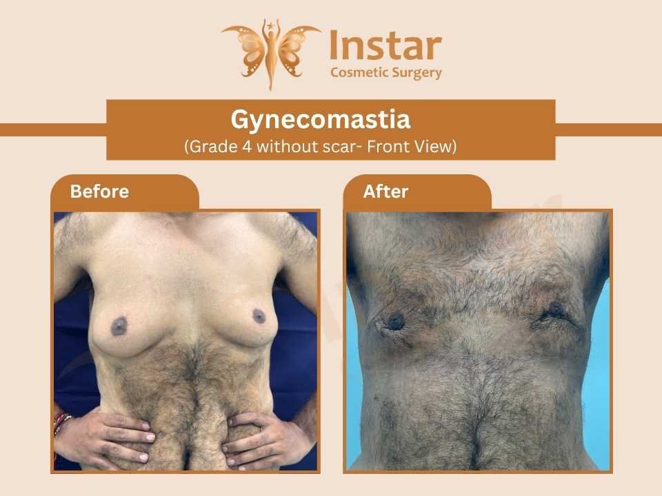 Gynecomastia-Grade4-without-scar-Front-View