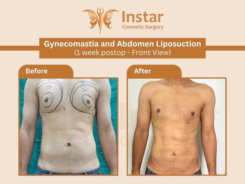 Gynecomastia-and-Abdomen-Liposuction-1week-postop-Front-View