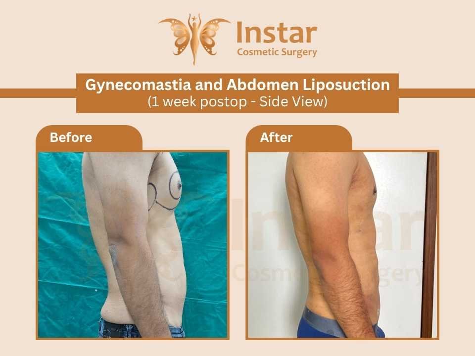Gynecomastia-and-Abdomen-Liposuction-1week-postop-Side-View