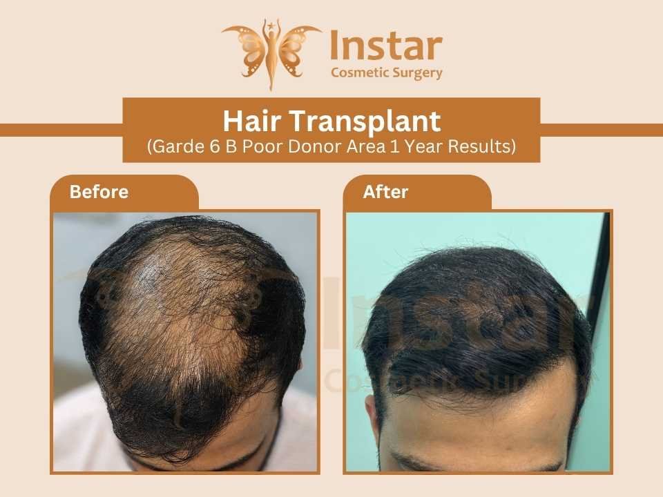 Hair-Transplant-Garde6B-Poor-Donor-Area-1-Year-Results