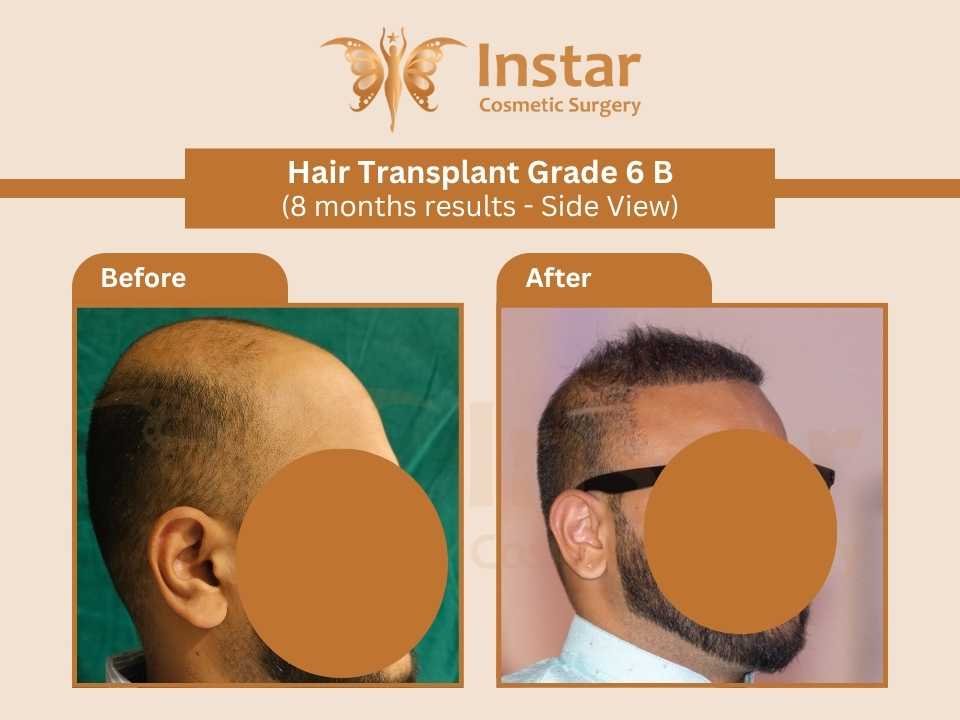 Hair-Transplant-Grade-6B-8months-results-Side-View