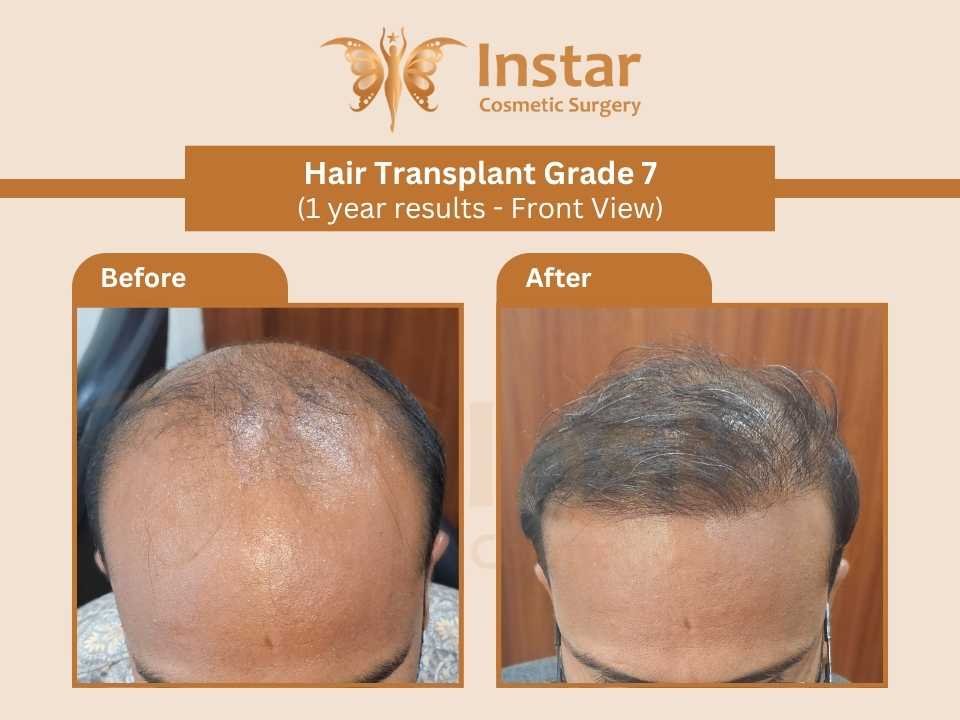 Hair-Transplant-Grade7-1year-results-Front-View