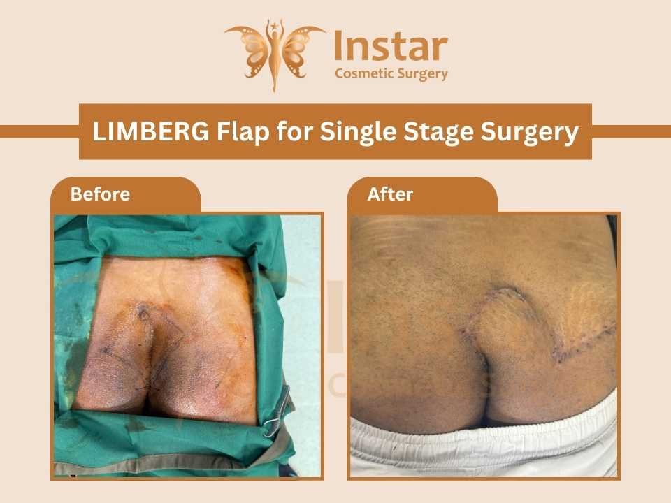 LIMBERG-Flap-for-single-stage-surgery