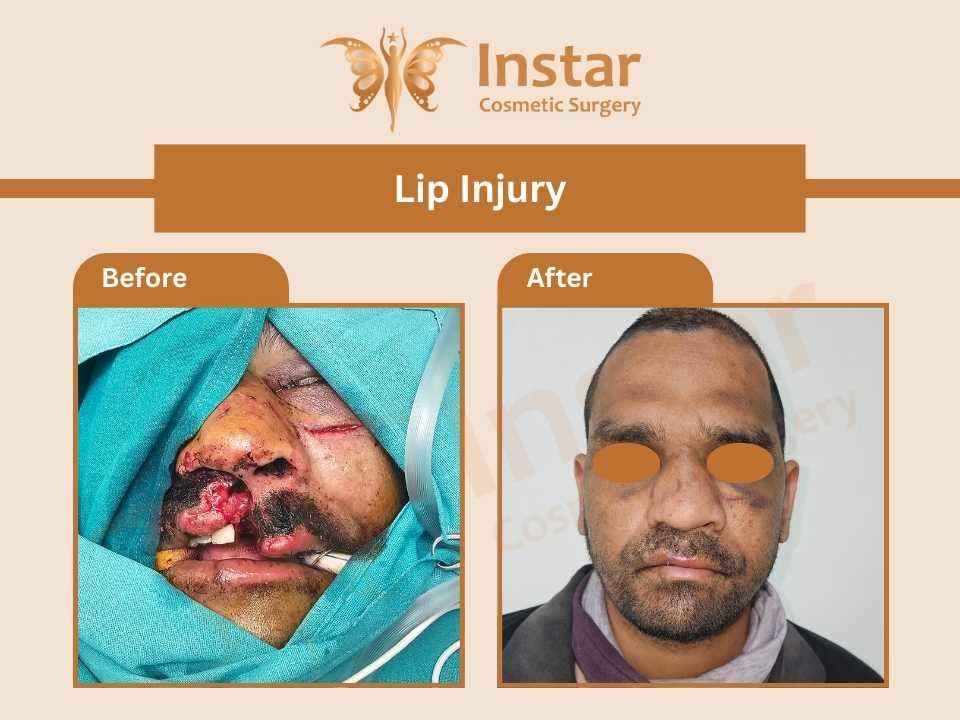 Lip-Injury