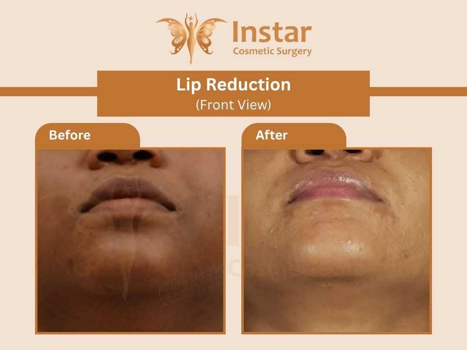 Lip-Reduction-Front-View